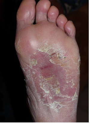 عکس اگزمای کف پا