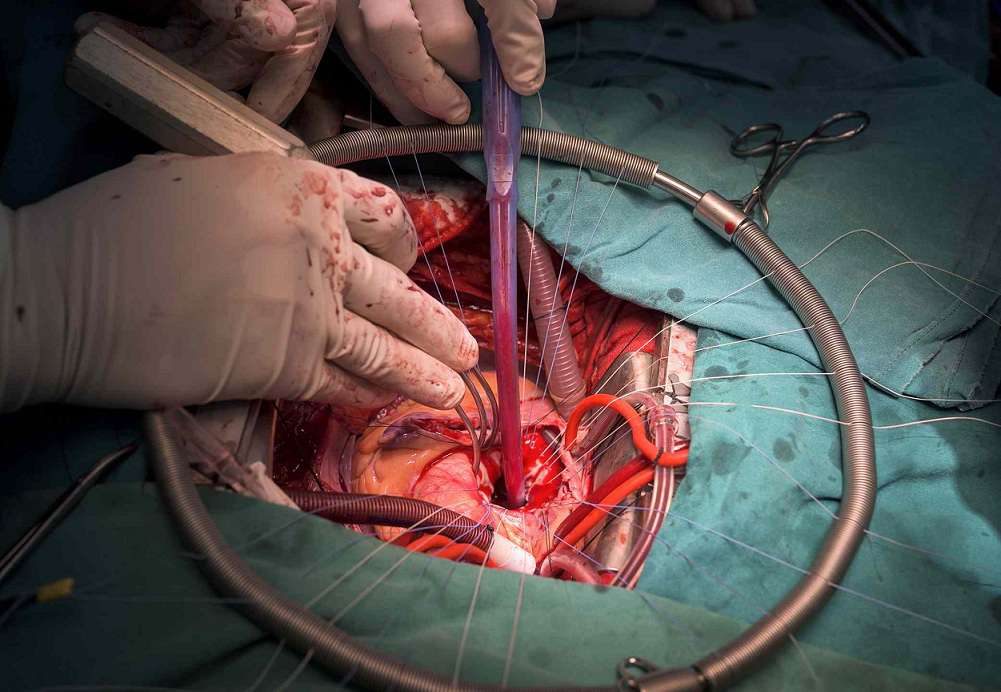 در طول جراحی قلب باز