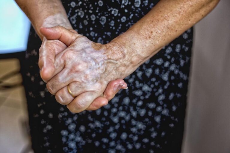 علائم واریس دست