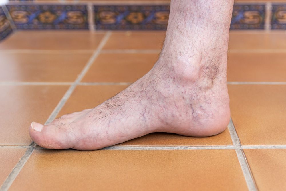 انواع بیماری های عروقی پا