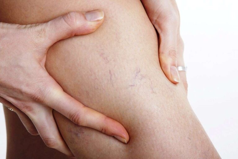 درمانهای اصولی واریس