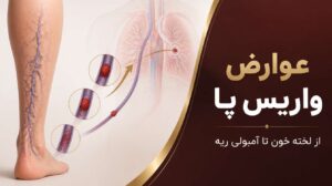 عوارض واریس پا